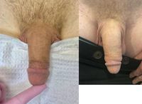 Penis Enlargement with Filler