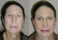 Facelift, Upper Blepharoplasty, Forehead Lift