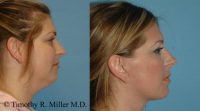 Lower facial rejuvenation