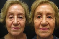 75 and up year old woman treated with Eyelid Surgery