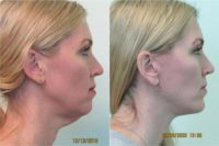 45-50 year old woman treated with Lower Facelift, Necklift, and Silicone Chin Implant