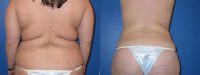 Brazilian Buttocks Lift- Liposuction of abdomen & back and fat grafts to buttocks