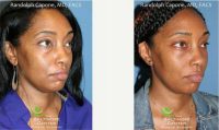 Dr. Randolph Capone, MD, FACS, Baltimore Facial Plastic Surgeon - 35 Year Old Woman Treated With Eyelid Surgery.