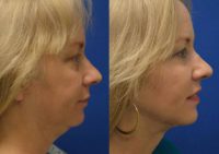 45-54 year old woman treated with Non-Surgical Neck Lift