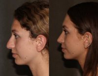 18 year old woman treated with Rhinoplasty