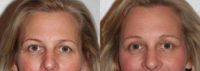 Woman treated with Brow Lift