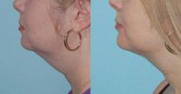 35-44 year old woman treated with Chin Liposuction