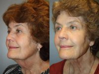 65-74 year old woman treated with Smart Lipo