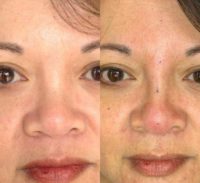 45-54 year old woman treated with threads for Nonsurgical Nose Job