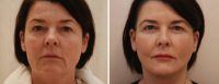 54 year old female; face & neck lift surgery with upper and lower blepharoplasty (eyelids)