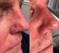 45-54 year old man treated with Laser Genesis