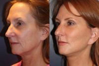 55-64 year old woman treated with SMAS Facelift