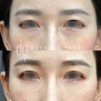Lower Blepharoplasty (Eye Bags Treatment)