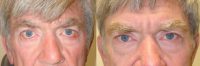 Ectropion surgery and Canthoplasty