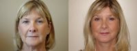 Face lift, Brow lift & Blepharoplasty