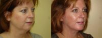 Facelift, Chin Implant and Blepharoplasty