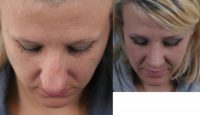 Woman with nose surgery
