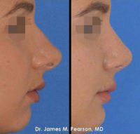 Rhinoplasty / Nose Reshaping and Chin Augmentation