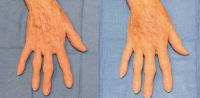 Hand Rejuvenation with Fat Transfer