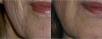 Juvederm remedies mouth wrinkles around mouth and cheeks