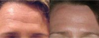 Woman Treated With Botox to Soften Forehead Lines