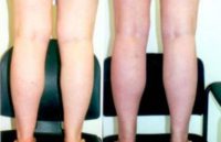Liposuction of calves and ankles