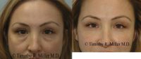 Lower eyelid rejuvenation