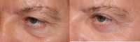 Male Cosmetic Eyelid Surgery