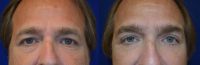 Male Upper & Lower Eyelid Surgery