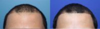 Male with receding frontal hairline and scalp thinning treated with Hair Regeneration PRP+ACell