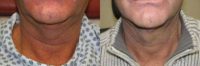 Man treated with Chin Liposuction