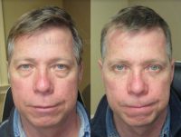 Man treated with Eye Bags Treatment