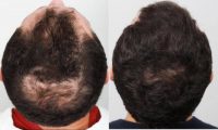 Man treated with FUE Hair Transplant