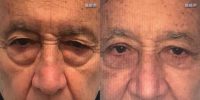 Man treated with Eyelid Surgery