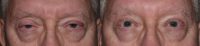 Man treated with Ptosis Surgery