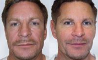 Man treated with Sculptra Aesthetic
