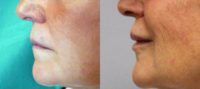 Woman in her early 60s treated with Lip Augmentation