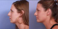 Woman treated with Nose Surgery
