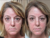 Woman treated with Eye Bags Treatment