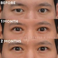 Natural Blepharoplasty (Double eyelid surgery)