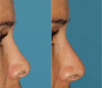 Nonsurgical rhinoplasty/nose job with Restylane Filler