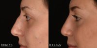Rhinoplasty Before & After 4 Months, performed by Dr. Kian Karimi at Rejuva Medical Aesthetics