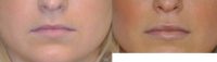 Permalip lip implant for young women that desired permanent and natural lip augmentation