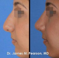 Rhinoplasty / Nose Reshaping in Middle Eastern Female