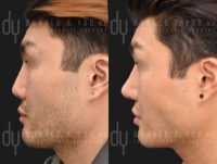 Revision Rhinoplasty with Rib Cartilage and DCF