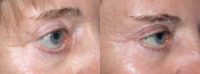 Revision Eyelid Surgery - Retraction Repair