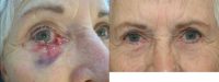 Right lower eyelid full thickness defect