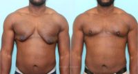 Skin Excision and Nipple Grafting For Severe Gynecomastia