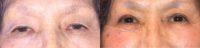 Woman treated with Ptosis Surgery