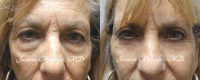 Upper and Lower Blepharoplasty with Ptosis Repair